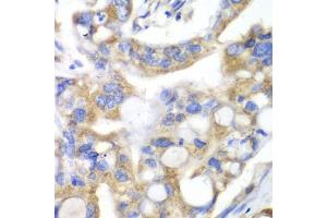 Immunohistochemistry of paraffin-embedded human liver cancer using PNLIP antibody (ABIN5975718) at dilution of 1/100 (40x lens). (PNLIP antibody)