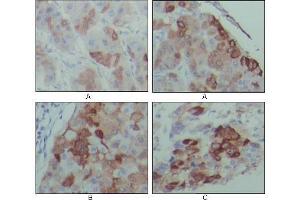 Immunohistochemical analysis of paraffin-embedded human hepatocarcinoma (A), breast carcinoma (B) and lung cancer tissues (C), showing cytoplasmic localization with DAB staining using PEG10 antibody.
