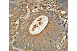 ACOX1 antibody immunohistochemistry analysis in formalin fixed and paraffin embedded human colon carcinoma (ACOX1 antibody)