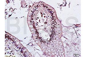 Formalin-fixed and adjacent noncancerous of human colon tissue labeled with Anti-Mel18/ZNF144 Polyclonal Antibody, Unconjugated (ABIN1386149) at 1:200 followed by conjugation to the secondary antibody and DAB staining (PCGF2 antibody  (AA 170-210))