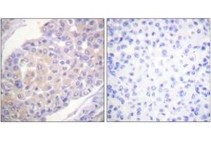 Immunohistochemistry analysis of paraffin-embedded human breast carcinoma, using p130 Cas (Phospho-Tyr165) Antibody. (BCAR1 antibody  (pTyr165))
