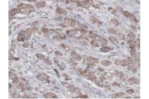 Detection of UBE2L3 in Human Breast Cancer Tissue using Polyclonal Antibody to Ubiquitin Conjugating Enzyme E2L3 (UBE2L3) (UBE2L3 antibody  (AA 4-154))