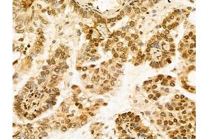 ABIN7094276 and ABIN7098323 at 1/100 staining Human lung cancer by IHC-P. (Histone Cluster 1, H1t (HIST1H1T) (Internal Region) antibody)
