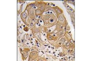 Formalin-fixed and paraffin-embedded human lung carcinoma tissue reacted with PTRF antibody (N-term), which was peroxidase-conjugated to the secondary antibody, followed by DAB staining. (PTRF antibody  (N-Term))