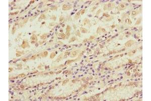 Immunohistochemistry of paraffin-embedded human gastric cancer using ABIN7145604 at dilution of 1:100
