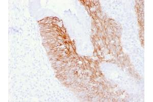 Formalin-fixed, paraffin-embedded human Cervix Carcinoma stained with CD44v6 Mouse Monoclonal Antibody (2F10). (CD44 antibody)