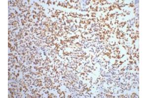 IHC staining of Human small cell carcinoma of lung tissue, diluted at 1:200. (ENO2/NSE antibody)