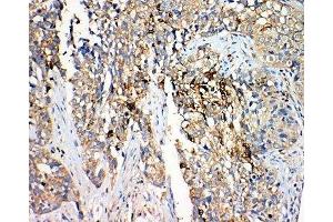 IHC-P: 17-beta-Hydroxysteroid dehydrogenase 4 antibody testing of human lung cancer tissue (HSD17B4 antibody  (C-Term))