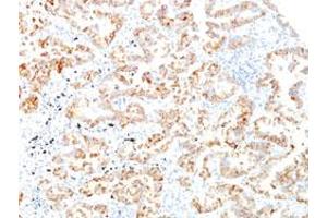 Immunohistochemical staining (Formalin-fixed paraffin-embedded sections) of human lung squamous cell carcinoma with KRT7 monoclonal antibody, clone SPM270 . (Cytokeratin 7 antibody)