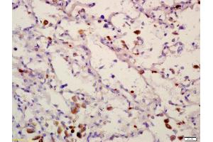 Formalin-fixed and paraffin embedded human lung carcinoma labeled with Anti-PPM1D Polyclonal Antibody, Unconjugated (ABIN740415) at 1:200 followed by conjugation to the secondary antibody and DAB staining (PPM1D antibody  (AA 201-300))