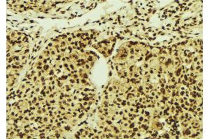 ABIN6274516 at 1/100 staining Human breast cancer tissue by IHC-P. (ZNF287 antibody)