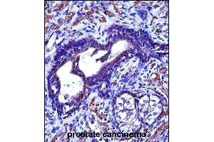 ACTG2 Antibody (C-term) (ABIN657460 and ABIN2846487) immunohistochemistry analysis in formalin fixed and paraffin embedded human prostate cancinoma followed by peroxidase conjugation of the secondary antibody and DAB staining. (ACTG2 antibody  (C-Term))