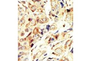 Formalin-fixed and paraffin-embedded human cancer tissue reacted with the primary antibody, which was peroxidase-conjugated to the secondary antibody, followed by DAB staining. (IGF1R antibody  (N-Term))