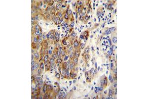 CYP2B6 Antibody immunohistochemistry analysis in formalin fixed and paraffin embedded human hepatocarcinoma followed by peroxidase conjugation of the secondary antibody and DAB staining. (CYP2B6 antibody  (AA 235-263))