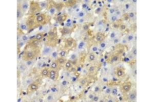 Immunohistochemistry of paraffin-embedded Human liver damage using Desmoplakin Polyclonal Antibody at dilution of 1:100 (40x lens). (Desmoplakin antibody)