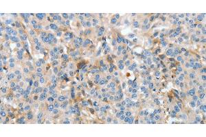 Immunohistochemistry of paraffin-embedded Human esophagus cancer using APOH Polyclonal Antibody at dilution of 1:30 (APOH antibody)