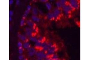 Immunofluorescence analysis of Human lung cancer tissue using CD68 Monoclonal Antibody at dilution of 1:200. (CD68 antibody)