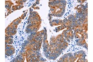 The image on the left is immunohistochemistry of paraffin-embedded Human colon cancer tissue using ABIN7130460(NR4A2 Antibody) at dilution 1/20, on the right is treated with fusion protein. (NR4A2 antibody)
