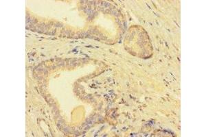 Immunohistochemistry of paraffin-embedded human prostate cancer using ABIN7173233 at dilution of 1:100