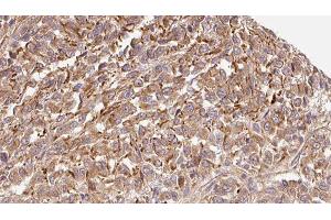 ABIN6279337 at 1/100 staining Human Melanoma tissue by IHC-P. (CST7 antibody  (N-Term))