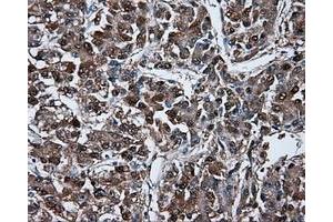 Immunohistochemical staining of paraffin-embedded Carcinoma of liver tissue using anti-BHMT mouse monoclonal antibody. (BHMT antibody)
