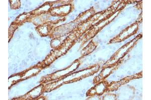 Formalin-fixed, paraffin-embedded human Renal Cell Carcinoma stained with KSP-Cadherin Rabbit Polyclonal Antibody. (Cadherin-16 antibody)