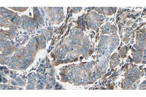 ABIN6273629 at 1/100 staining Human cervical cancer tissue by IHC-P. (GBP2 antibody  (Internal Region))