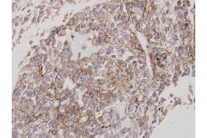 Immunohistochemical staining of paraffin-embedded Lung CA using Flotillin 2 antibody at a dilution of 1:100 (Flotillin 2 antibody)
