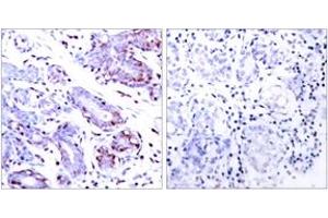 Immunohistochemistry analysis of paraffin-embedded human breast carcinoma tissue, using STAT1 (Ab-701) Antibody.