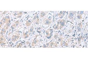 Immunohistochemistry of paraffin-embedded Human liver cancer tissue using GPCPD1 Polyclonal Antibody at dilution of 1:55(x200) (GPCPD1 antibody)