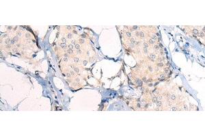 Immunohistochemistry of paraffin-embedded Human breast cancer tissue using ANAPC15 Polyclonal Antibody at dilution of 1:50(x200) (ANAPC15 antibody)