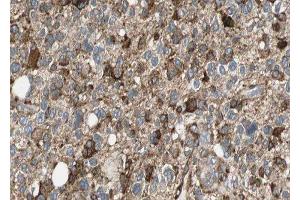 ABIN6277081 at 1/100 staining human Glioma tissue sections by IHC-P.