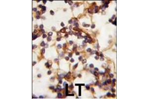 Formalin-fixed and paraffin-embedded human Lymph tissue reacted with Rictor antibody (N-term) (ABIN391384 and ABIN2841392) , which was peroxidase-conjugated to the secondary antibody, followed by DAB staining. (RICTOR antibody  (N-Term))