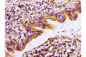 Immunohistochemistry of paraffin-embedded human lung cancer using ABIN7143021 at dilution of 1:100
