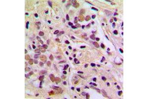Immunohistochemical analysis of AATF staining in human breast cancer formalin fixed paraffin embedded tissue section. (AATF antibody  (N-Term))