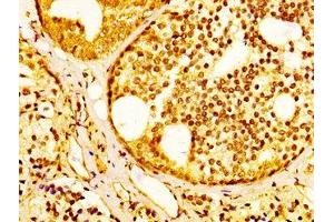 IHC image of ABIN7170259 diluted at 1:300 and staining in paraffin-embedded human prostate cancer performed on a Leica BondTM system. (SLC45A3 antibody  (AA 408-487))