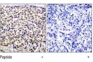 Immunohistochemical analysis of paraffin-embedded human breast carcinoma tissue using CREB1 polyclonal antibody  . (CREB1 antibody  (Ser129))