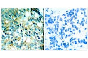Immunohistochemical analysis of paraffin- embedded human breast carcinoma tissue using Src (phospho- Tyr418) antibody. (Src antibody  (pTyr418))