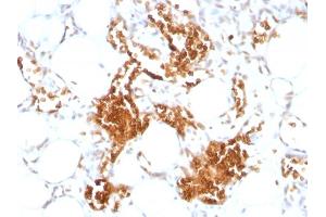 Formalin-fixed, paraffin-embedded human Angiosarcoma stained with Glycophorin A Monoclonal Antibody (SPM599) (CD235a/GYPA antibody)