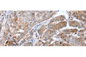 Immunohistochemistry of paraffin-embedded Human breast cancer tissue using CALB2 Polyclonal Antibody at dilution of 1:25(x200) (Calretinin antibody)
