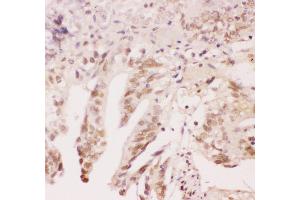 Anti-ATF1 Picoband antibody,  IHC(P): Human Intestinal Cancer Tissue (AFT1 antibody  (AA 1-271))