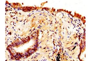 IHC image of ABIN7144516 diluted at 1:370 and staining in paraffin-embedded human lung cancer performed on a Leica BondTM system. (Aquaporin 4 antibody  (AA 253-323))