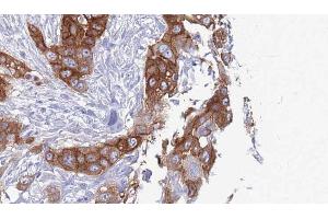 ABIN6272741 at 1/100 staining Human Head and neck cancer tissue by IHC-P. (TAS2R38 antibody  (Internal Region))