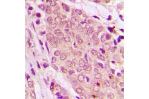 Immunohistochemical analysis of SMAD2/3 staining in human breast cancer formalin fixed paraffin embedded tissue section. (Smad2/3 antibody  (N-Term))