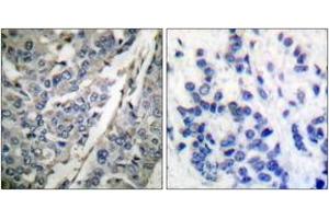 Immunohistochemistry analysis of paraffin-embedded human breast carcinoma, using Synaptotagmin (Phospho-Thr202) Antibody. (Synaptotagmin antibody  (pThr202))