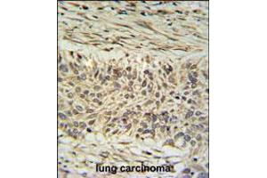 DDX23 Antibody IHC analysis in formalin fixed and paraffin embedded lung carcinoma followed by peroxidase conjugation of the secondary antibody and DAB staining. (DDX23 antibody  (AA 248-277))