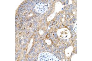 Immunohistochemistry of paraffin-embedded human colon carcinoma using Cation-independent M6PR (IGF2R) antibody (ABIN7267905) at dilution of 1:200 (40x lens).