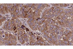 ABIN6273838 at 1/100 staining Human liver cancer tissue by IHC-P. (HTR3E antibody  (Internal Region))