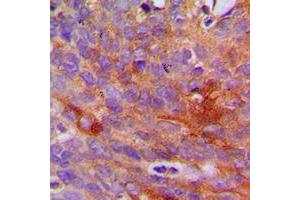 Immunohistochemical analysis of Collagen 1 alpha 2 staining in human breast cancer formalin fixed paraffin embedded tissue section.