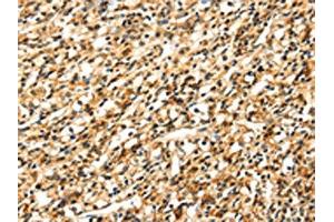 The image on the left is immunohistochemistry of paraffin-embedded Human prostate cancer tissue using ABIN7131054(SIGLEC12 Antibody) at dilution 1/35, on the right is treated with fusion protein. (SIGLEC12 antibody)